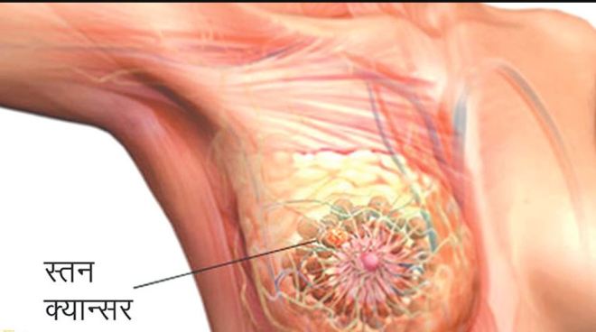 स्तन क्यान्सर भएका महिलाले नेपालमै स्तन फेर्न सक्ने